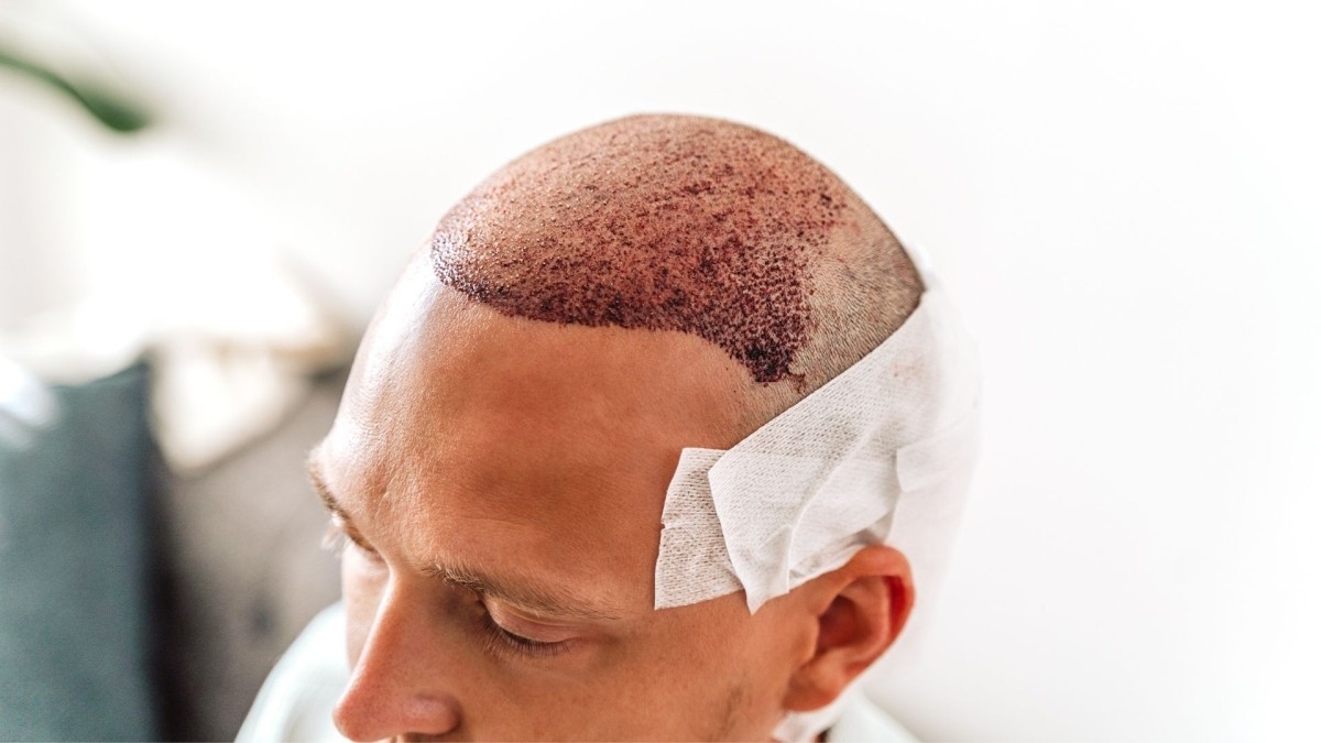 Uzmanı uyardı: Yazın saç ektirenler 1 ay güneşin altında kalmasın